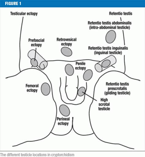 undescended testicles in baby